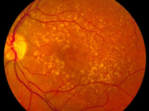 Intermediate age-related macular degeneration